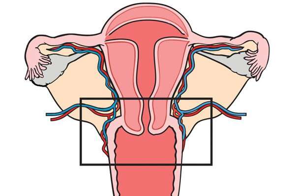 Diagram of uterus with a box around the cervix and surrounding tissue to showcase what is removed during radical trachelectomy.