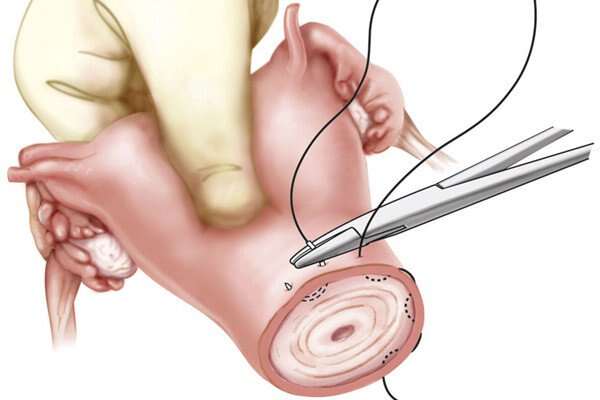 Diagram highlighting how a suture is added where the newly created cervix and vagina will join during radical trachelectomy.