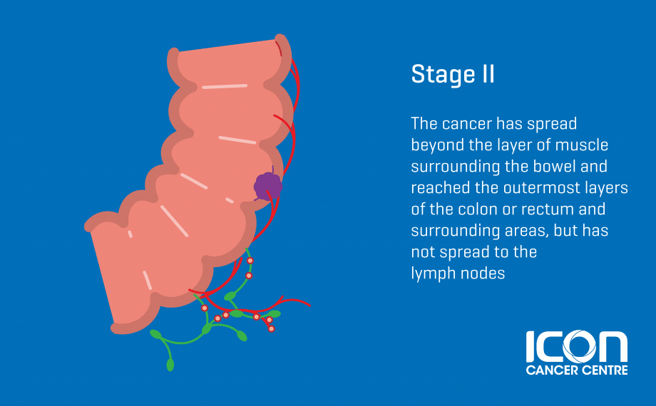 1695281467527201.png Bowel-Cancer-Stage-2_Singapore-920x570.png