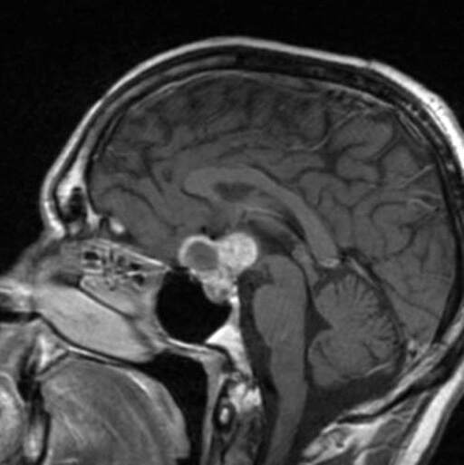 1698844085382329.jpg Craniopharyngioma.jpg