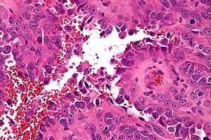 Angiosarcoma - Libre Pathology