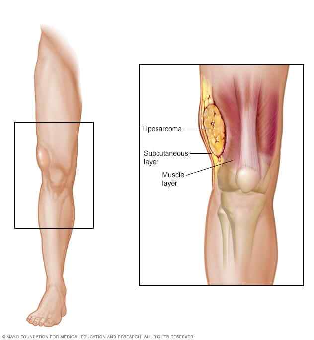 Liposarcoma - Symptoms and causes - Mayo Clinic