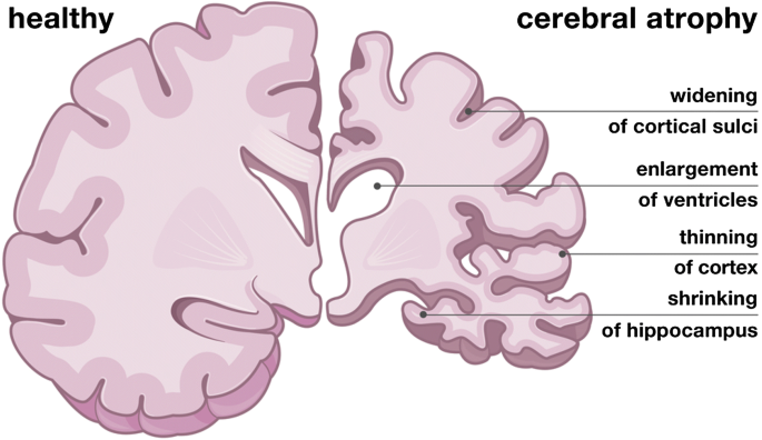 The Shrinking Brain: Cerebral Atrophy Following Traumatic Brain Injury |  Annals of Biomedical Engineering