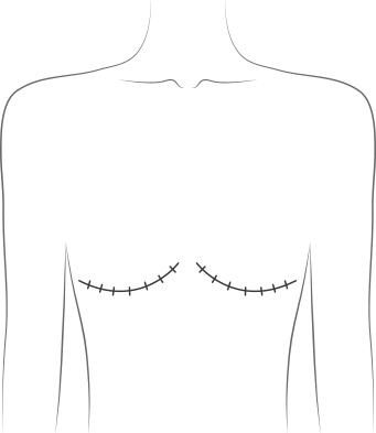 预防乳腺癌能够做到什么程度？什么是乳腺癌预防性手术？