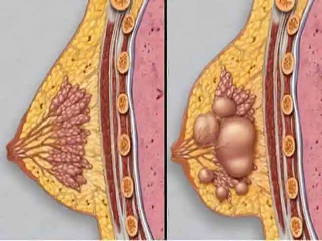 复发性乳腺癌