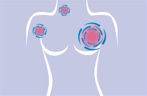 乳腺癌已经扩散的迹象有哪些？