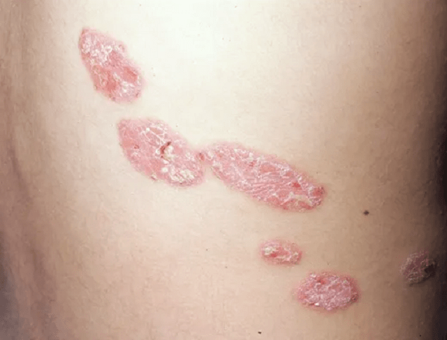 乳房佩吉特病是什么病？如何治疗？