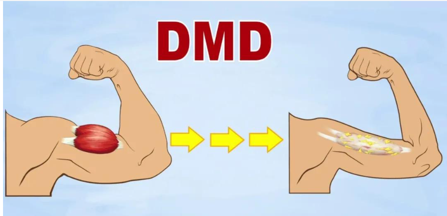 谈谈DMD互助社区的必要性