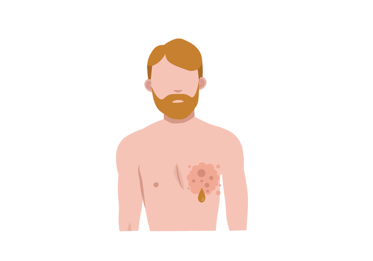 男性乳腺癌